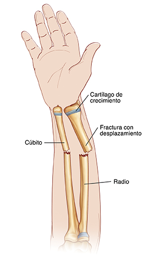 Vista de la palma de la mano y antebrazo donde pueden verse el radio y el cúbito. Se ven fracturas desplazadas que cruzan el radio y el cúbito. Los extremos de los huesos no están alineados. Las placas de crecimiento se encuentran cerca de la muñeca.
