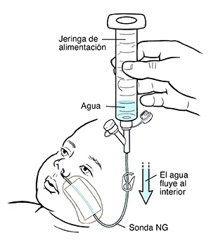 Mano sosteniendo una jeringa llena de agua conectada a una sonda nasogástrica de un niño pequeño. El agua fluye desde la jeringa hasta la sonda.