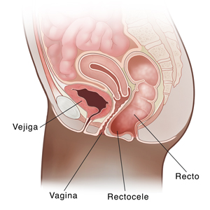 Vista lateral de un corte transversal de una pelvis femenina donde se muestra el recto que cuelga hacia el interior de la vagina, lo que se conoce como rectocele.
