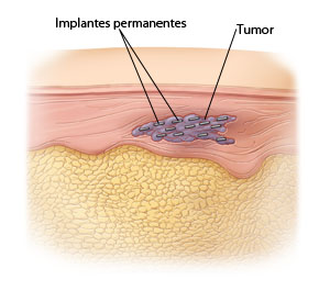 Corte transversal de la piel donde se ve un tumor con 13 pequeños gránulos en su interior.