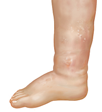 Vista lateral de una pierna que muestra hinchazón del tobillo y el pie.
