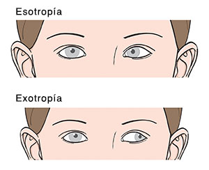 Primer plano de ojos visto desde el frente donde pueden verse esotropía y exotropía.