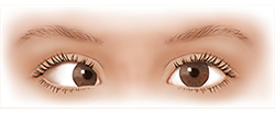 Vista frontal de los ojos de un niño donde puede verse un ojo extraviado.