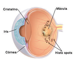 Vista del corte transversal de un ojo en el que se ven manchas de histoplasmosis que rodean la mácula.