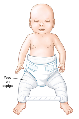 Bebé con yeso en espiga en la parte inferior del tronco y las piernas. Una barra une el yeso en el extremo inferior de las piernas.