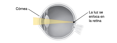 Corte transversal de un ojo que muestra la luz enfocándose en la retina.