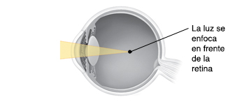 Corte transversal de un ojo donde puede verse la luz que se enfoca delante de la retina.