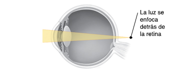 Corte transversal de un ojo que muestra la luz enfocándose detrás de la retina.
