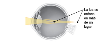 Corte transversal de un ojo donde puede verse la luz que se enfoca en más de un lugar.