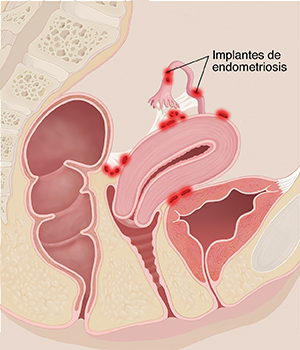 Vista lateral de la sección transversal de la pelvis de una mujer en la que pueden verse las áreas inflamadas en caso de endometriosis.