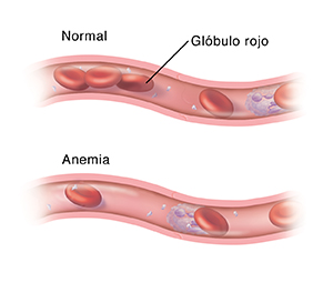 Corte transversal de un vaso sanguíneo con cantidades normales de glóbulos rojos. Abajo se ve otro corte transversal de un vaso sanguíneo que muestra que hay muy pocos glóbulos rojos debido a una anemia.