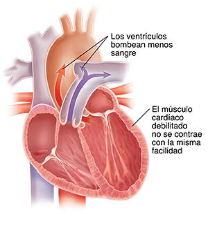 Corte transversal de corazón dilatado con insuficiencia cardíaca sistólica.