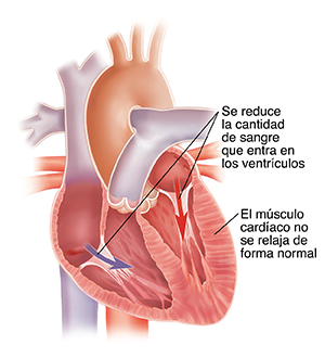 Corte transversal de un corazón con insuficiencia cardíaca diastólica.