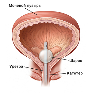 Vista frontal del sistema urinario masculino que muestra la vejiga, la uretra, la próstata y los músculos del piso pélvico.