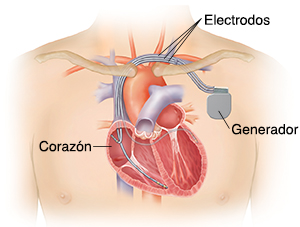 Contorno del pecho de un hombre en el que puede verse un marcapasos y DAI biventricular colocado con tres cables que van hacia las cámaras del corazón.