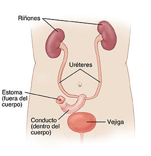 Vista delantera de un torso, donde pueden verse los riñones conectados al conducto y el estoma por medio de los uréteres. La vejiga no está conectada a los uréteres.