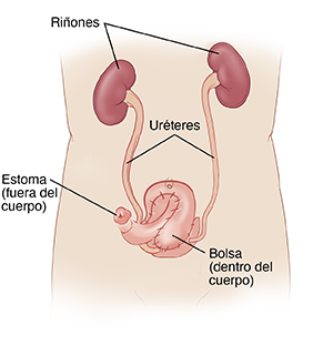 Vista delantera de un torso masculino, donde pueden verse los riñones conectados a la bolsa interna y el estoma por medio de los uréteres.