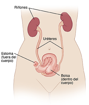 Vista delantera de un torso femenino, donde pueden verse los riñones conectados a la bolsa y al estoma por medio de los uréteres.