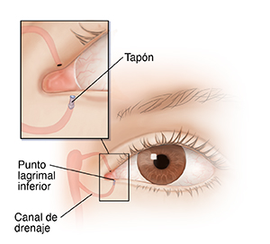 Vista frontal de un ojo que muestra un tapón en el sistema de drenaje del ojo.
