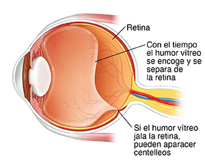 Corte transversal de un ojo donde se observa el humor vítreo encogiéndose y tirando de la retina.