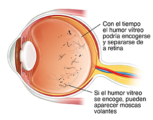 Corte transversal de un ojo donde se observa el humor vítreo encogiéndose y las moscas volantes.
