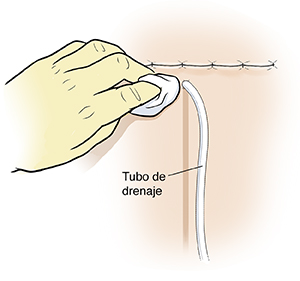 Primer plano de una mano con guante que limpia la piel alrededor del tubo de drenaje cerca de la incisión quirúrgica.