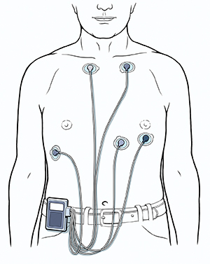 Torso de un hombre que muestra cinco cables de electrocardiograma conectados al pecho y a un monitor Holter sujeto al cinturón.