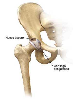 Vista frontal de la articulación de la cadera con artritis.