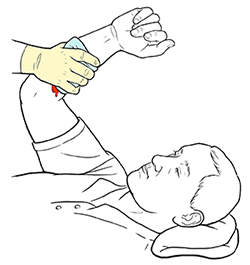 Mano enguantada que sostiene una compresa contra una herida sangrante en el brazo de un hombre.