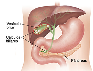 Contorno del torso que muestra el hígado y el estómago con un corte transversal de la vesícula biliar con cálculos.