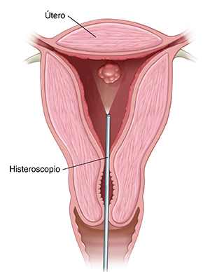 Corte transversal del útero en el que se ve el histeroscopio.