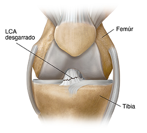 Vista frontal de la articulación de la rodilla donde puede verse un LCA desgarrado.