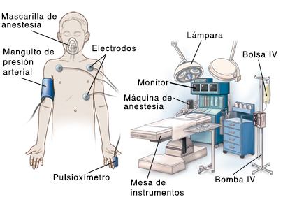 Contorno de un niño con mascarilla de anestesia sobre la cara, manguito para medir la presión arterial en la parte superior del brazo, manguito dl oxímetro de pulso en el dedo y electrodos sobre el pecho. En el fondo se ve la mesa de operaciones, el soporte IV (vía intravenosa), la bolsa IV, el carro de anestesia, el monitor y la luz del quirófano.