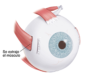Vista de tres cuartos del ojo que muestra el músculo de la parte exterior del ojo. El área sombreada indica la parte del músculo que debe extraerse.