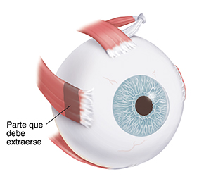 Vista de tres cuartos del ojo que muestra el músculo de la parte exterior del ojo. El músculo se cortó, se volvió a colocar y se suturó a la esclerótica.