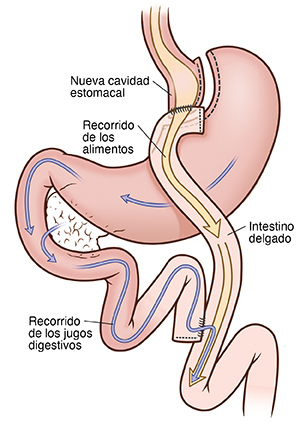 Vista frontal del estómago en la que se observa una cirugía de derivación gástrica en Y de Roux. Las flechas indican el recorrido de los alimentos y los líquidos digestivos.