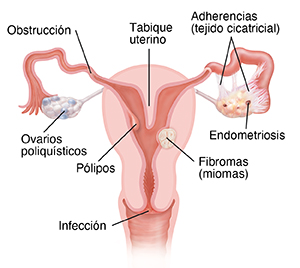 Vista anterior de un corte transversal de la vagina, el cuello del útero, las trompas de Falopio y los ovarios. Se muestra un ovario poliquístico. El bloqueo se presenta en la trompa de Falopio. Está creciendo un fibroma (mioma) en la pared del útero. El ovario presenta tejido endometrial. Hay adhesiones que conectan el ovario con la trompa de Falopio. El tabique es una pared de tejido dentro del útero. Está creciendo un pólipo en la pared del útero. Se presenta una infección en el cuello uterino.