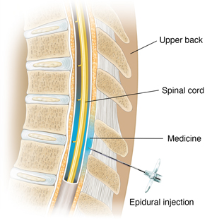 Corte transversal de la columna torácica con una aguja insertada justo fuera del saco alrededor de la médula espinal.