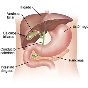 Contorno de un torso donde pueden verse el hígado y el estómago con un corte transversal de la vesícula con cálculos (piedras).