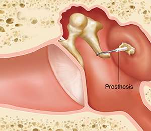 Cross section of ear showing outer, inner, and middle ear structures with prosthesis replacing damaged stapes.