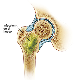 Vista frontal de la sección transversal de la articulación de la cadera que muestra una infección en el hueso de la pierna.